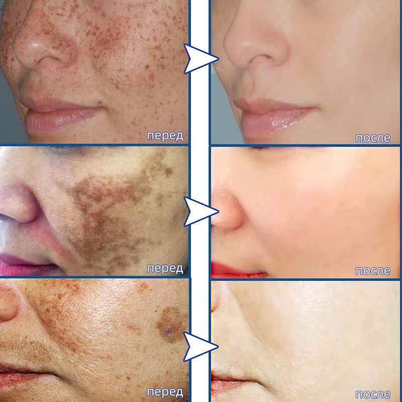 Powerful Spot-removing Whiteni - Korean Skincare Routine recensie en prijs